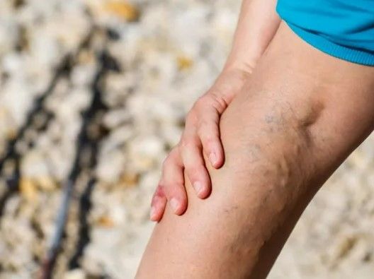 Varicose Veins and Leg Health: What You Should Know