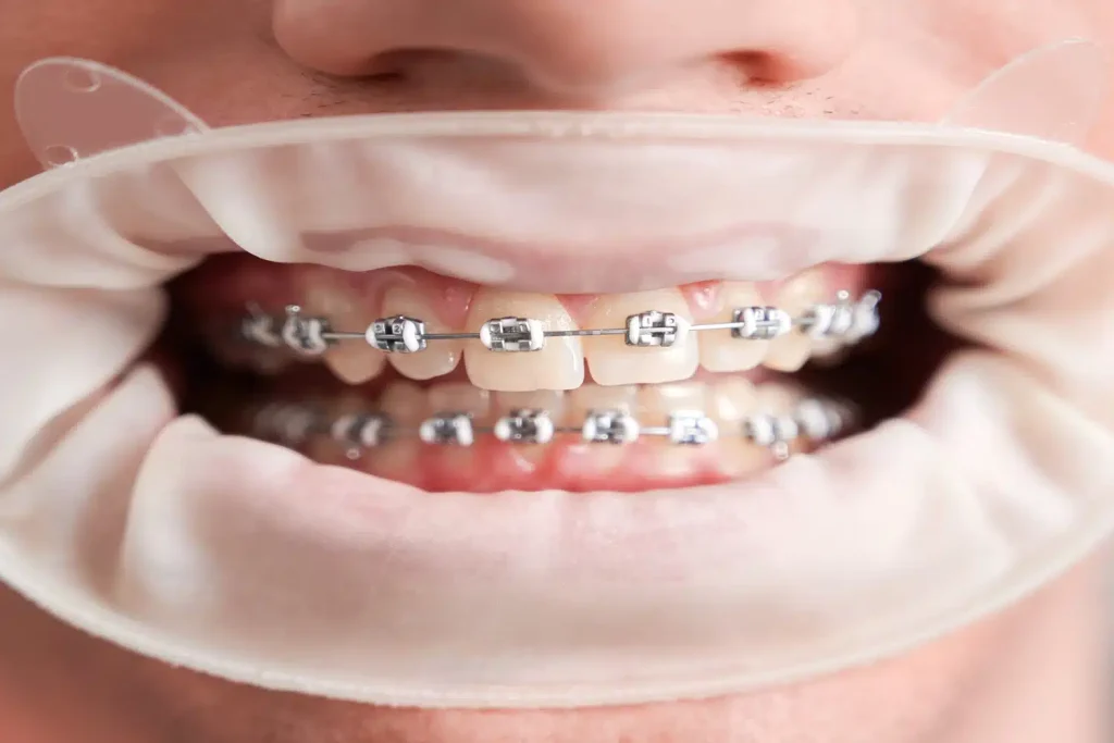 What Makes Braces In Johns Creek Worth Your Investment