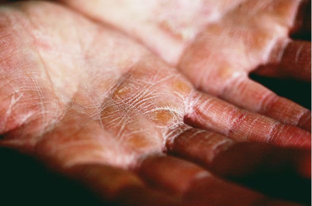 Why Early Treatment of Common Childhood Skin Infections Matters More Than Parents Realize