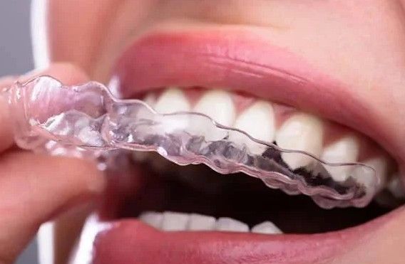 THE EVOLUTION OF ORTHODONTIC TREATMENTS: FROM METAL BRACES TO CLEAR ALIGNERS