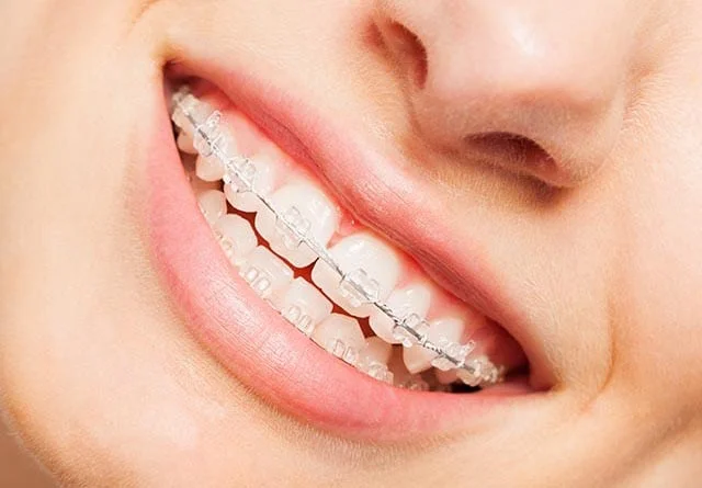 THE EVOLUTION OF ORTHODONTIC TREATMENTS: FROM METAL BRACES TO CLEAR ALIGNERS