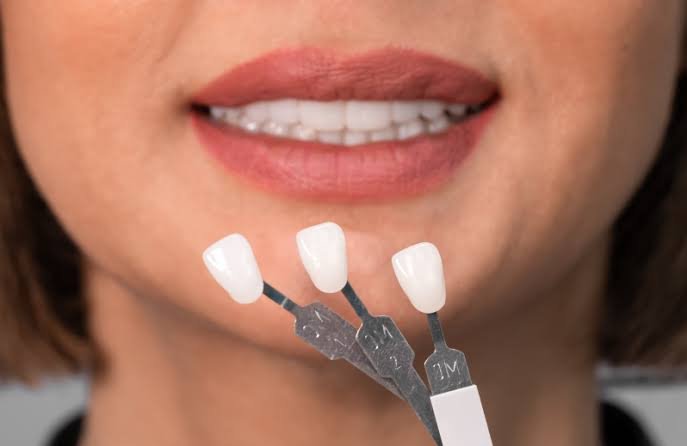 Are Porcelain Veneers Worth It? Questions to Ask First